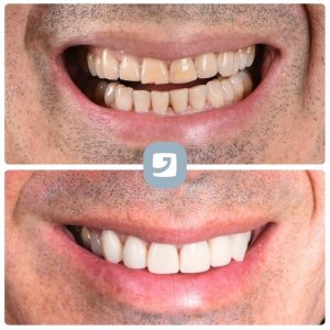 Faccette-Dentali-Ortodonzia-Linguale-Catania-2